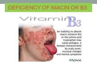 DEFICIENCY OF NIACIN OR B3
 