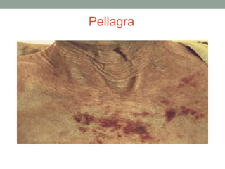 Pellagra
 