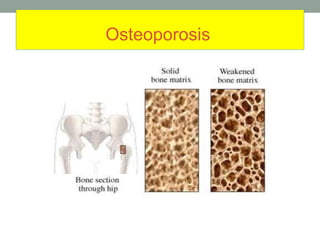 Osteoporosis
 