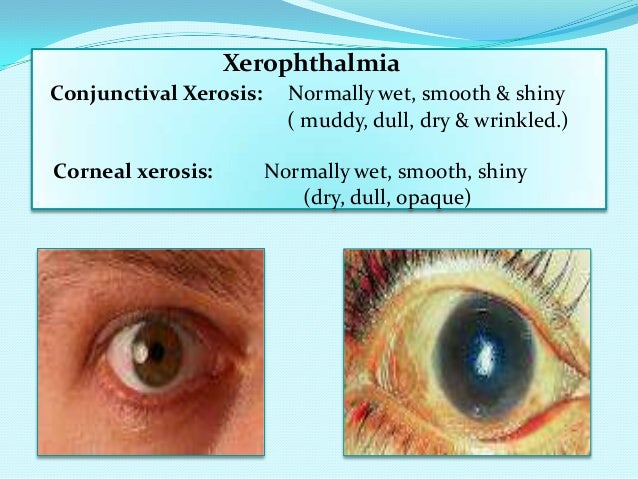 Xerosis Conjunctiva