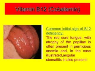 Vitamin B12 (Cobalamin)Vitamin B12 (Cobalamin)
Common initial sign of B12
deficiency:
The red sore tongue, with
atrophy of the papillae is
often present in pernicious
anemia and, in the case
illustrated,angular
stomatitis is also present.
 