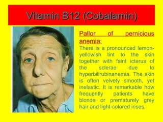 Vitamin B12 (Cobalamin)Vitamin B12 (Cobalamin)
Pallor of pernicious
anemia:
There is a pronounced lemon-
yellowish tint to the skin
together with faint icterus of
the sclerae due to
hyperbilirubinanemia. The skin
is often velvety smooth, yet
inelastic. It is remarkable how
frequently patients have
blonde or prematurely grey
hair and light-colored irises.
 