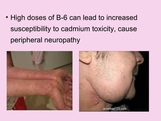 • High doses of B-6 can lead to increased
susceptibility to cadmium toxicity, cause
peripheral neuropathy
 