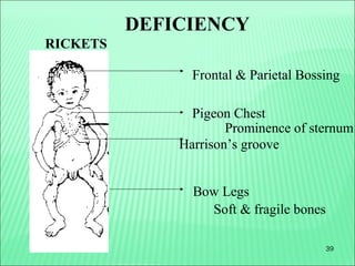 39
Bow Legs
Frontal & Parietal Bossing
Pigeon Chest
Soft & fragile bones
Prominence of sternum
DEFICIENCY
RICKETS
Harrison’s groove
 