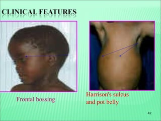42
Frontal bossing
Harrison's sulcus
and pot belly
 