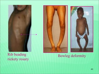 43
Rib beading
rickety rosary
Bowleg deformity
 