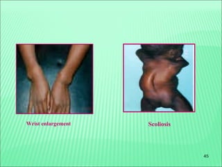 45
ScoliosisWrist enlargement
 