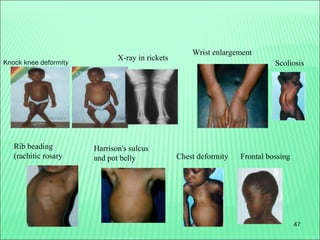 47
Knock knee deformity
Wrist enlargement
Rib beading
(rachitic rosary
Harrison's sulcus
and pot belly Chest deformity Frontal bossing
Scoliosis
X-ray in rickets
 