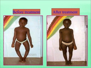 54
Before treatment After treatment
 