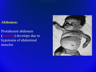 Protuberant Vitamin D and Rickets, and management...Dr Saubhik Das | PPT