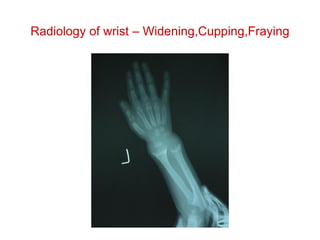Radiology of wrist – Widening,Cupping,Fraying
 