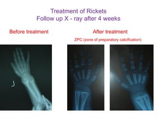 Vit d deficiency rickets 2021 | PDF