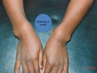 Widening of wrist joints
Widening of
wrists
 