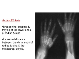 Active Rickets:
•Broadening, cupping &
fraying of the lower ends
of radius & ulna.
•Increased distance
between the distal ends of
radius & ulna & the
metacarpal bones.
 