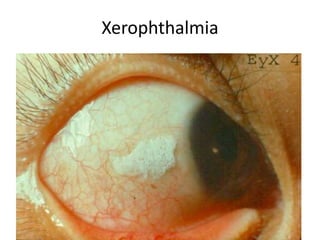 Xerophthalmia
 