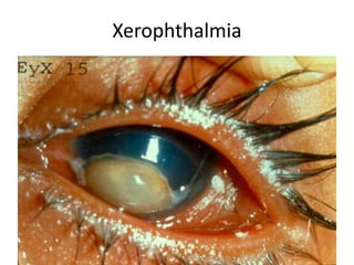 Xerophthalmia
 