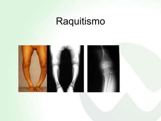 Raquitismo
 