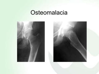 Osteomalacia
 