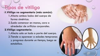 Tipos de vitiligo
1.Vitiligo no segmentario (más común):
1.Afecta ambos lados del cuerpo de
forma simétrica.
2.Suele comenzar en manos, cara o
alrededor de orificios corporales.
2.Vitiligo segmentario:
1.Afecta solo un lado o parte del cuerpo.
2.Tiende a aparecer a edades tempranas
y progresa durante un tiempo, luego se
estabiliza.
 