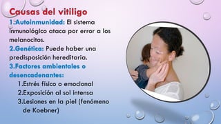 El sistema
inmunológico ataca por error a los
melanocitos.
Puede haber una
predisposición hereditaria.
1.Estrés físico o emocional
2.Exposición al sol intensa
3.Lesiones en la piel (fenómeno
de Koebner)
 