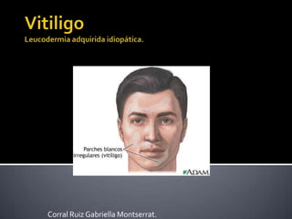 VitiligoLeucodermia adquirida idiopática. Corral Ruiz Gabriella Montserrat. 