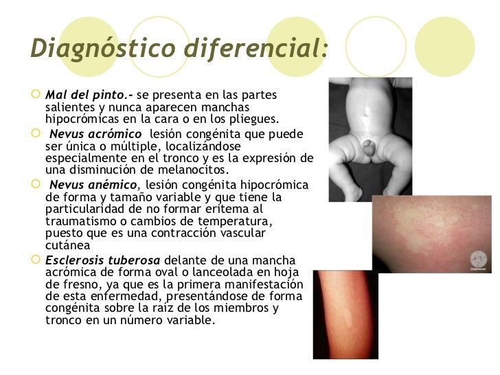 Vitiligo