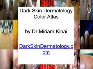 Dark Skin Dermatology
      Color Atlas

  by Dr Miriam Kinai

DarkSkinDermatology.c
         om
 