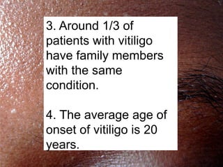 3. Around 1/3 of
patients with vitiligo
have family members
with the same
condition.

4. The average age of
onset of vitiligo is 20
years.
 