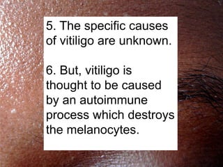 5. The specific causes
of vitiligo are unknown.

6. But, vitiligo is
thought to be caused
by an autoimmune
process which destroys
the melanocytes.
 