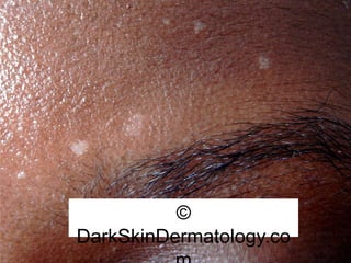 ©
DarkSkinDermatology.co
 