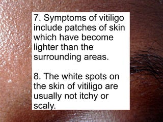 7. Symptoms of vitiligo
include patches of skin
which have become
lighter than the
surrounding areas.

8. The white spots on
the skin of vitiligo are
usually not itchy or
scaly.
 