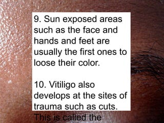 9. Sun exposed areas
such as the face and
hands and feet are
usually the first ones to
loose their color.

10. Vitiligo also
develops at the sites of
trauma such as cuts.
This is called the
 