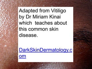 Adapted from Vitiligo
by Dr Miriam Kinai
which teaches about
this common skin
disease.

DarkSkinDermatology.c
om
 