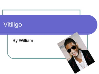 Vitiligo

   By William
 
