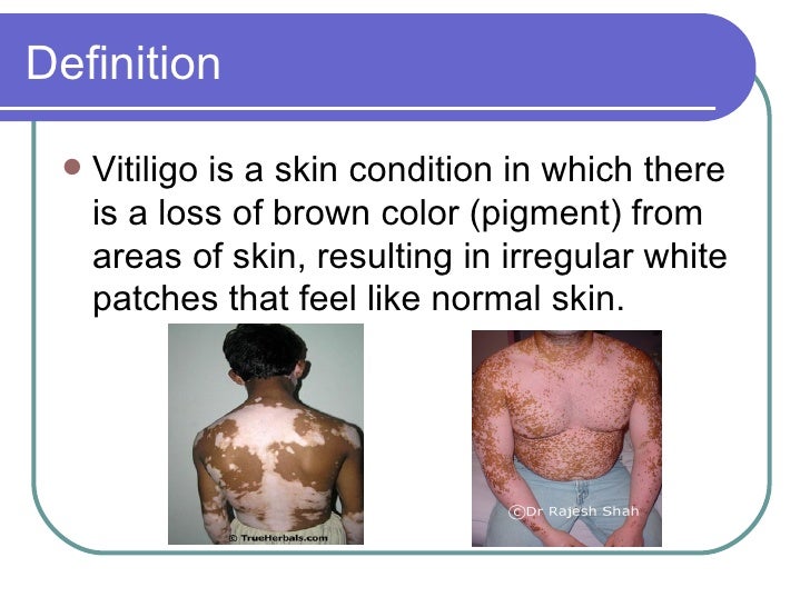 Vitiligo