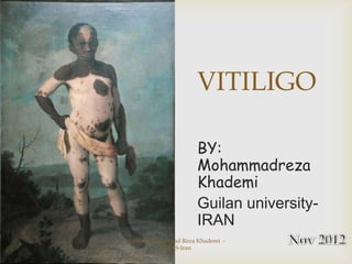 VITILIGO

                      BY:
                      Mohammadreza
                      Khademi
                      Guilan university-
                      IRAN
Author: Mohammad Reza Khademi -
           GUMS-Iran
 