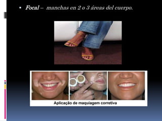  Focal – manchas en 2 o 3 áreas del cuerpo.
 