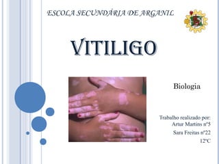 ESCOLA SECUNDÁRIA DE ARGANIL



     Vitiligo
                              Biologia



                        Trabalho realizado por:
                             Artur Martins nº5
                              Sara Freitas nº22
                                          12ºC
 
