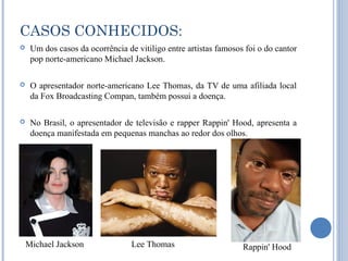 CASOS CONHECIDOS:
    Um dos casos da ocorrência de vitiligo entre artistas famosos foi o do cantor
     pop norte-americano Michael Jackson.

    O apresentador norte-americano Lee Thomas, da TV de uma afiliada local
     da Fox Broadcasting Compan, também possui a doença.

    No Brasil, o apresentador de televisão e rapper Rappin' Hood, apresenta a
     doença manifestada em pequenas manchas ao redor dos olhos.




    Michael Jackson               Lee Thomas                      Rappin' Hood
 