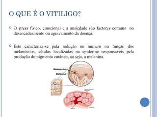 O QUE É O VITILIGO?
   O stress físico, emocional e a ansiedade são factores comuns no
    desencadeamento ou agravamento da doença.

   Este caracteriza-se pela redução no número ou função dos
    melanócitos, células localizadas na epiderme responsáveis pela
    produção do pigmento cutâneo, ao seja, a melanina.
 
