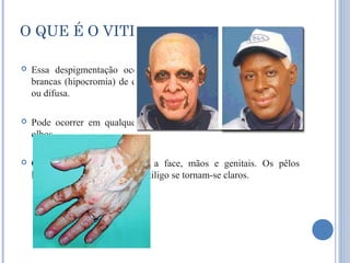 O QUE É O VITILIGO?

   Essa despigmentação ocorre geralmente em forma de manchas
    brancas (hipocromia) de diversos tamanhos e com destruição focal
    ou difusa.

   Pode ocorrer em qualquer segmento da pele, inclusivamente nos
    olhos.

   Os locais mais comuns são a face, mãos e genitais. Os pêlos
    localizados nas manchas de vitiligo se tornam-se claros.
 
