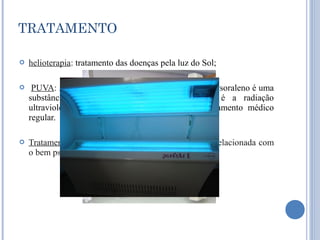 TRATAMENTO

   helioterapia: tratamento das doenças pela luz do Sol;

    PUVA: A sigla PUVA significa: Psolareno + UVA. Psoraleno é uma
    substância química sensível a radiação. UVA é a radiação
    ultravioleta. O tratamento é feito com acompanhamento médico
    regular.

   Tratamentos psicológicos, uma vez que a pele está relacionada com
    o bem psicológico da pessoa.
 