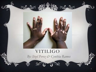 VITILIGO
By: Itzel Perez & Cynthia Ramos

1

 