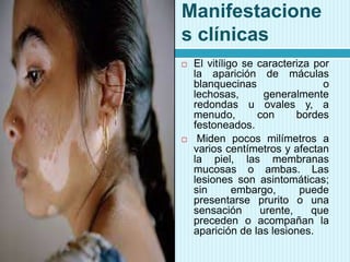Manifestacione
s clínicas




El vitíligo se caracteriza por
la aparición de máculas
blanquecinas
o
lechosas,
generalmente
redondas u ovales y, a
menudo,
con
bordes
festoneados.
Miden pocos milímetros a
varios centímetros y afectan
la piel, las membranas
mucosas o ambas. Las
lesiones son asintomáticas;
sin
embargo,
puede
presentarse prurito o una
sensación
urente,
que
preceden o acompañan la
aparición de las lesiones.

 