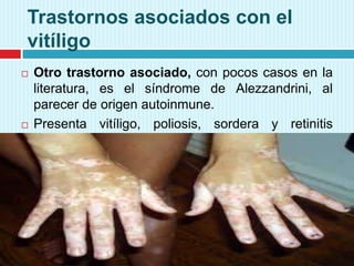 Trastornos asociados con el
vitíligo




Otro trastorno asociado, con pocos casos en la
literatura, es el síndrome de Alezzandrini, al
parecer de origen autoinmune.
Presenta vitíligo, poliosis, sordera y retinitis
unilateral.

 