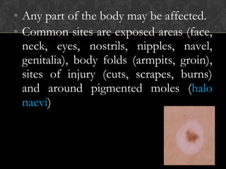 • Any part of the body may be affected.
• Common sites are exposed areas (face,
neck, eyes, nostrils, nipples, navel,
genitalia), body folds (armpits, groin),
sites of injury (cuts, scrapes, burns)
and around pigmented moles (halo
naevi)
 