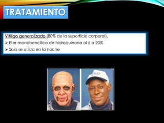 TRATAMIENTO
Vitiligo generalizado (80% de la superficie corporal).
 Eter monobencílico de hidroquinona al 5 a 20%
 Solo se utiliza en la noche
 