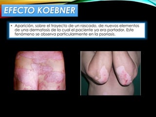 EFECTO KOEBNER
• Aparición, sobre el trayecto de un rascado, de nuevos elementos
de una dermatosis de la cual el paciente ya era portador. Este
fenómeno se observa particularmente en la psoriasis.
 