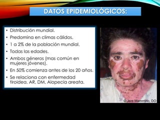 DATOS EPIDEMIOLÓGICOS:
• Distribución mundial.
• Predomina en climas cálidos.
• 1 a 2% de la población mundial.
• Todas las edades.
• Ambos géneros (mas común en
mujeres jóvenes).
• En 50% comienza antes de los 20 años.
• Se relaciona con enfermedad
tiroidea, AR, DM, Alopecia areata.
 