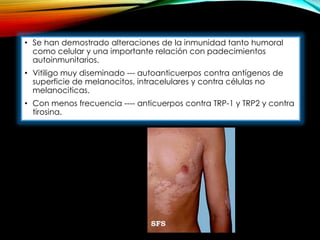 • Se han demostrado alteraciones de la inmunidad tanto humoral
como celular y una importante relación con padecimientos
autoinmunitarios.
• Vitiligo muy diseminado --- autoanticuerpos contra antígenos de
superficie de melanocitos, intracelulares y contra células no
melanociticas.
• Con menos frecuencia ---- anticuerpos contra TRP-1 y TRP2 y contra
tirosina.
 